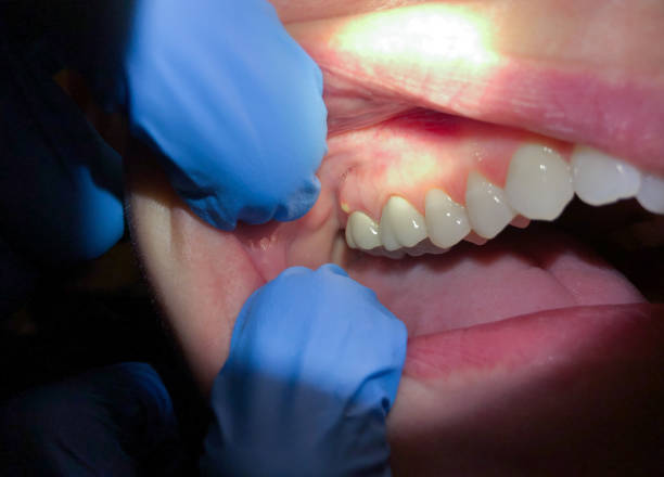 Best Emergency Dental Extractions in Plainview, TX